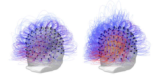Avant et après la stimulation du nerf vague. A droite, en jaune orangé, l’augmentation de l’activité cérébrale dans la région pariétale.