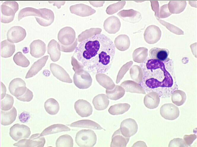 La drépanocytose est une maladie sanguine héréditaire.