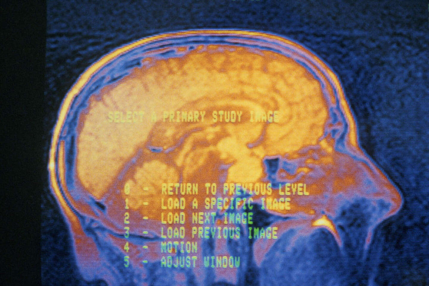 Migraine · Inserm, La science pour la santé