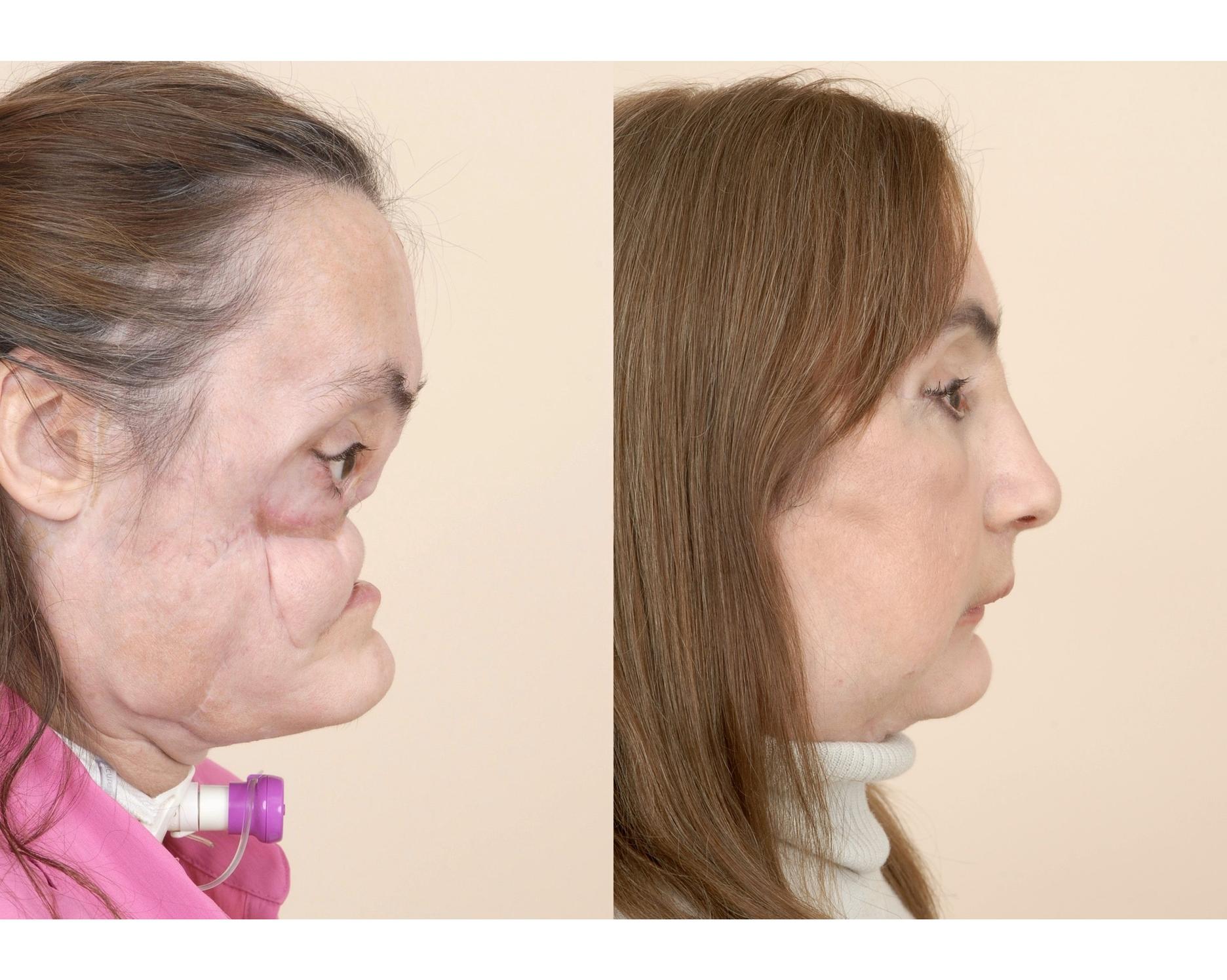 Une Américaine a reçu la première greffe de 80 du visage — free download