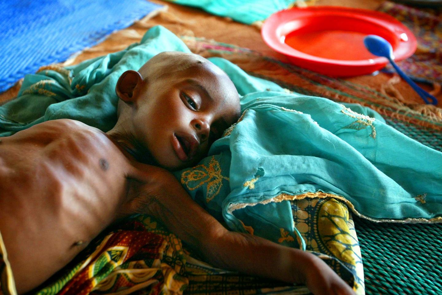 La malnutrition responsable de la mort de centaines d'enfants en bas