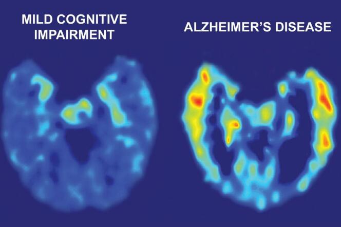 Une image de scanner montre, à gauche, le cerveau d'un patient volontaire souffrant de troubles cognitifs légers, et à droite, le cerveau d'un patient volontaire souffrant de la maladie d'Alzheimer.