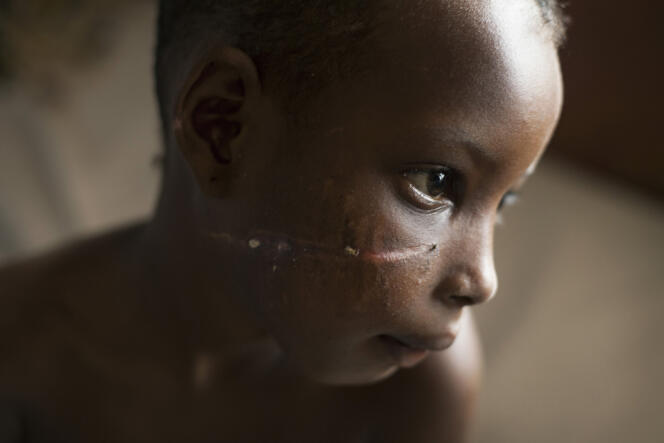 Nafissa, 10 ans, a reçu des coups de machettes sur le crâne et sur le visage.