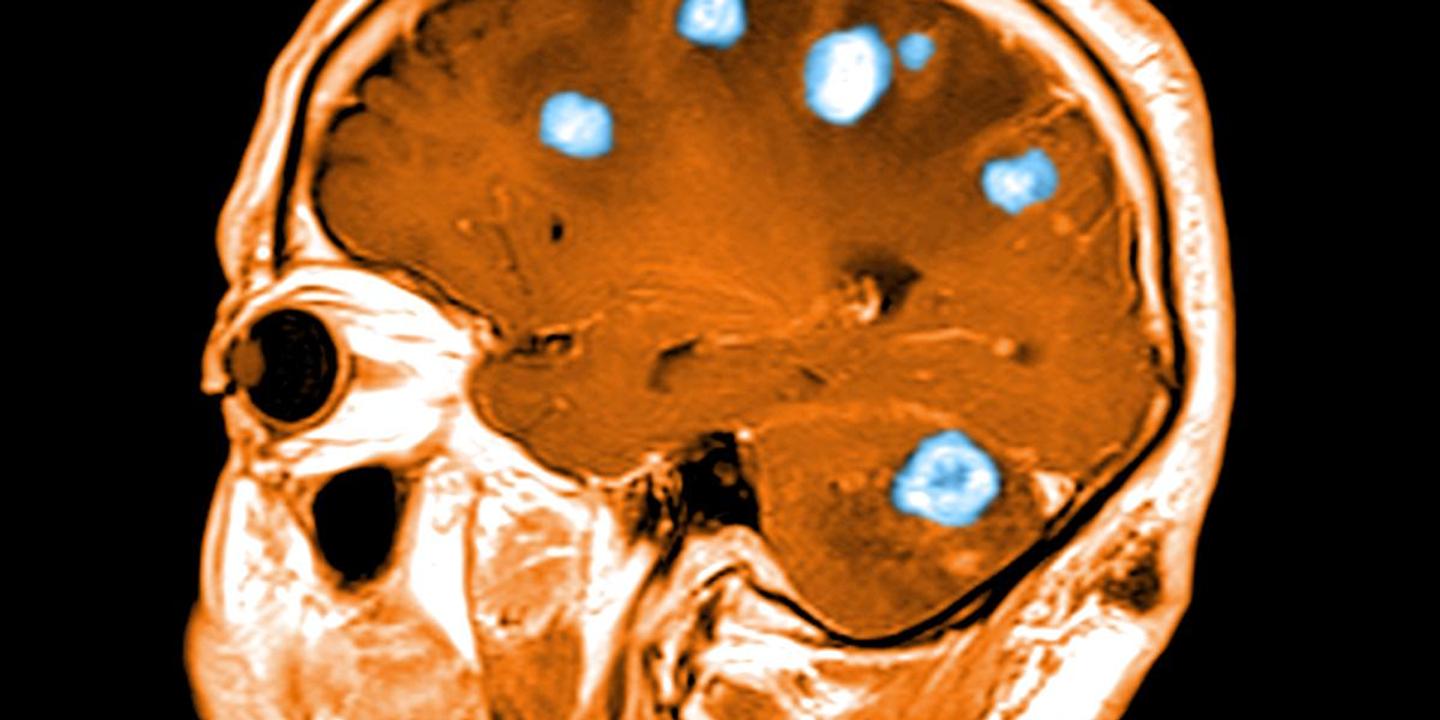 Métastases cérébrales : la fin du fatalisme