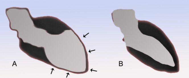 Schémas du ventricule gauche, l'un atteint de takotsubo cardiopathie (A), et l'autre normal (B).