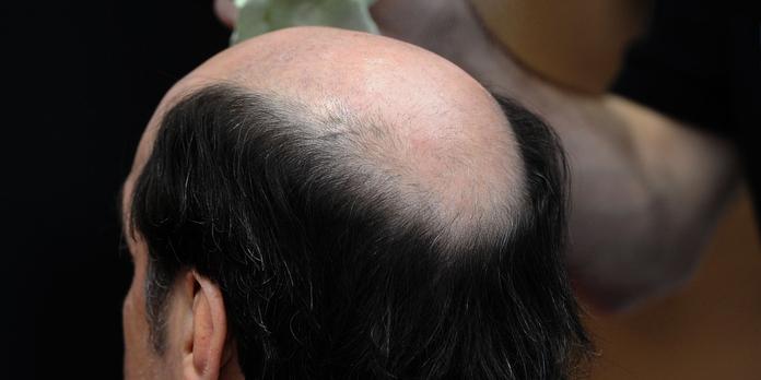 Calvitie homme precoce Clearance