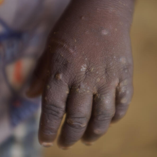 La main d’un enfant victime de démangeaisons que sa mère attribue à la toxicité de la mine.