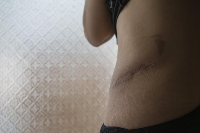 Kalila, réfugiée syrienne de 39 ans, ici au Liban en juin  2014, porte la cicatrice du prélèvement de son rein, vendu 15000 dollars (12600 euros).