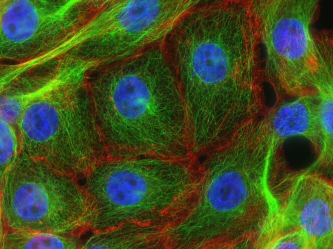 Microscopie en fluorescence des fibres de stress dans les cellules cancéreuses du sein.