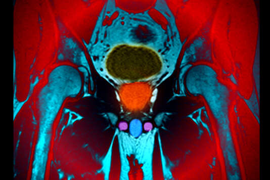 Vessie (en jaune), prostate (en orange), testicules (en violet) et pénis (en bleu). Imagerie par Résonance Magnétique (IRM).