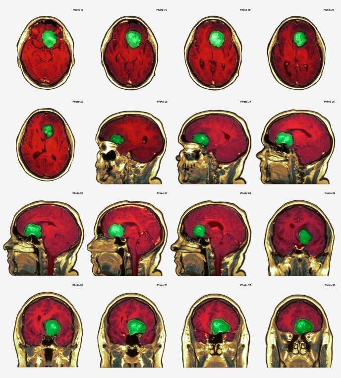 Méningiome (en vert) visible grâce à l’imagerie par résonance magnétique (IRM) chez une femme de 38 ans.