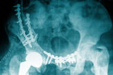 « Implant Files » : un scandale sanitaire mondial sur les implants médicaux