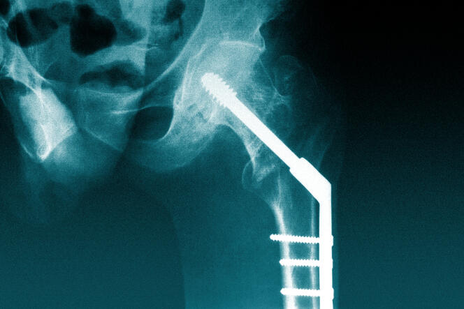 Prothèse de hanche, implant.