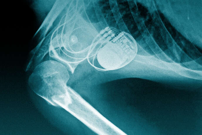Radiografía de un marcapasos