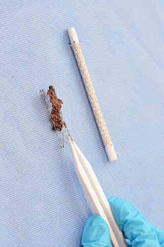 Un stent qui avait été implanté dans l’artère fémorale superficielle est analysé et photographié.