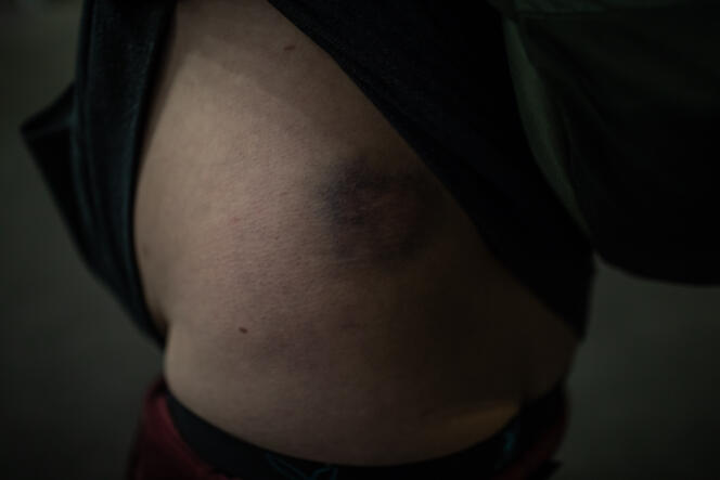 Un manifestant montre, le 3 décembre, à Paris, sa blessure à la suite à un tir de Flash-Ball, lors d’une manifestation des « gilets jaunes » deux jours plus tôt.