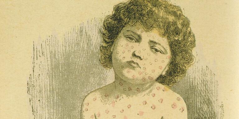 Child suffering from Measles  (Rubeola Morbilli), a widespread viral infection spread by air-borne droplets.  A routine vaccine was not available until 1964.  From Jules Rengade 'Les Grands Maux et les Grands Remedes', Paris, c1890.