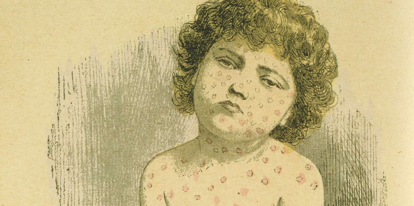 Niño que sufre de sarampión (Rubeola Morbilli), una propagación viral generalizada por gotitas en el aire.  Una vacunación de rutina no estuvo disponible hasta 1964. De Jules Rengade 'Las grandes mentiras y los grandes remedios', París, c1890.