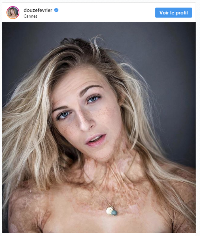 Sur Instagram, Julie assume ses brûlures. La représentation des corps différents dans la société est devenu son combat.