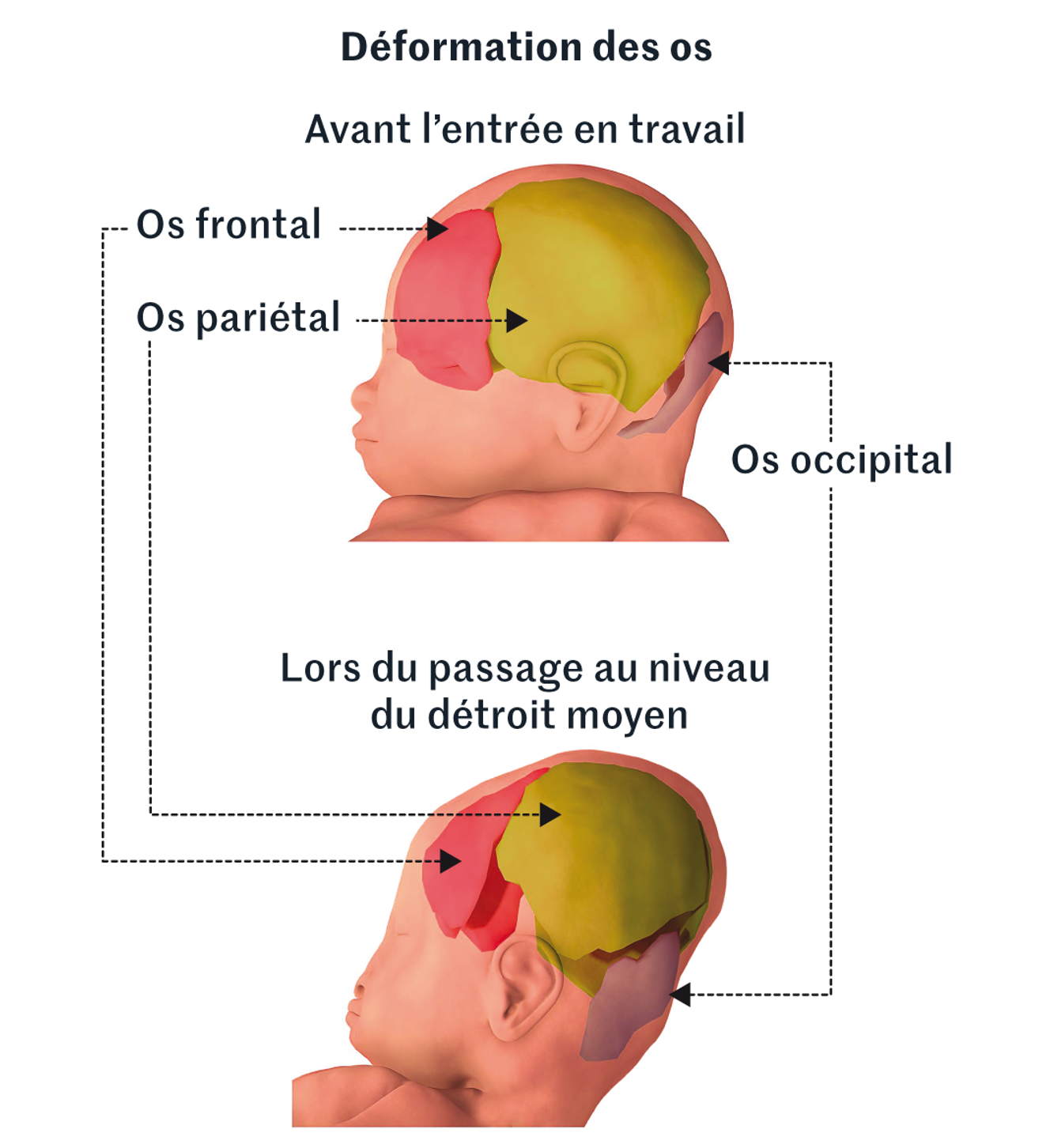 Comment le crâne d’un bébé se déforme à l’accouchement