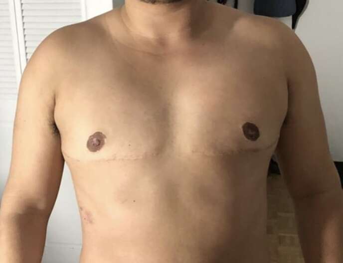 Résultat d’une mastectomie bilatérale avec greffe de mamelons.
