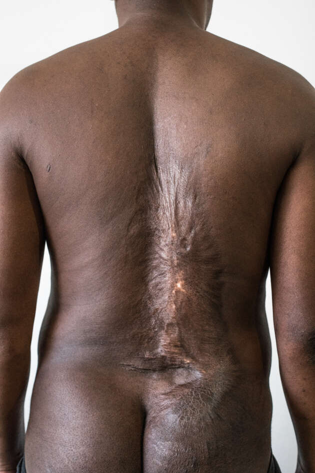 Parmi les migrants retrouvés par le photographe César Dezfuli en Europe, plusieurs avaient subi des tortures par brûlures lors de leur séquestration en Libye.