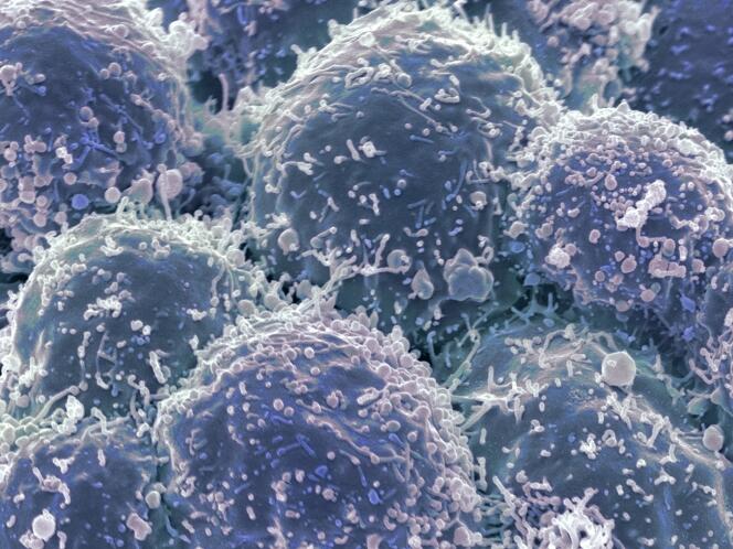Cellules cancéreuses d’un poumon.
