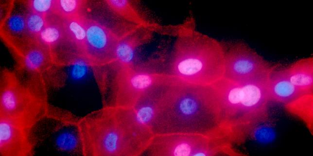 Le cancer devient la première cause de décès dans les pays riches