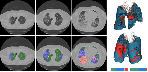 Image de poumons malades avec annotations (vert, bleu, rouge, jaune...) automatiques par un algorithme d’apprentissage machine des zones aidant au diagnostic du Covid-19.