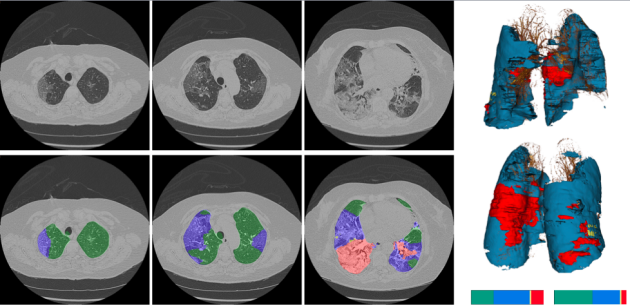Des poumons malades, avec annotations par algorithme d’apprentissage machine des zones aidant au diagnostic du Covid-19.