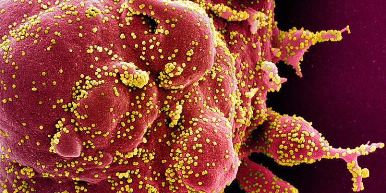 This handout image obtained on April 29, 2020 and released by the National Institute of Allergy and Infectious Diseases (NIAID) of the National Institutes of Health (NIH), shows a colorized scanning electron micrograph of an apoptotic cell (red) heavily infected with SARS-COV-2 virus particles (yellow), isolated from a patient sample captured at the NIAID Integrated Research Facility (IRF) in Fort Detrick, Maryland. (Photo by Handout / National Institute of Allergy and Infectious Diseases / AFP) / RESTRICTED TO EDITORIAL USE - MANDATORY CREDIT 