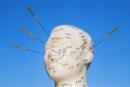 Acupuncture Needles in Model of Face Pas d'exclusivité possible