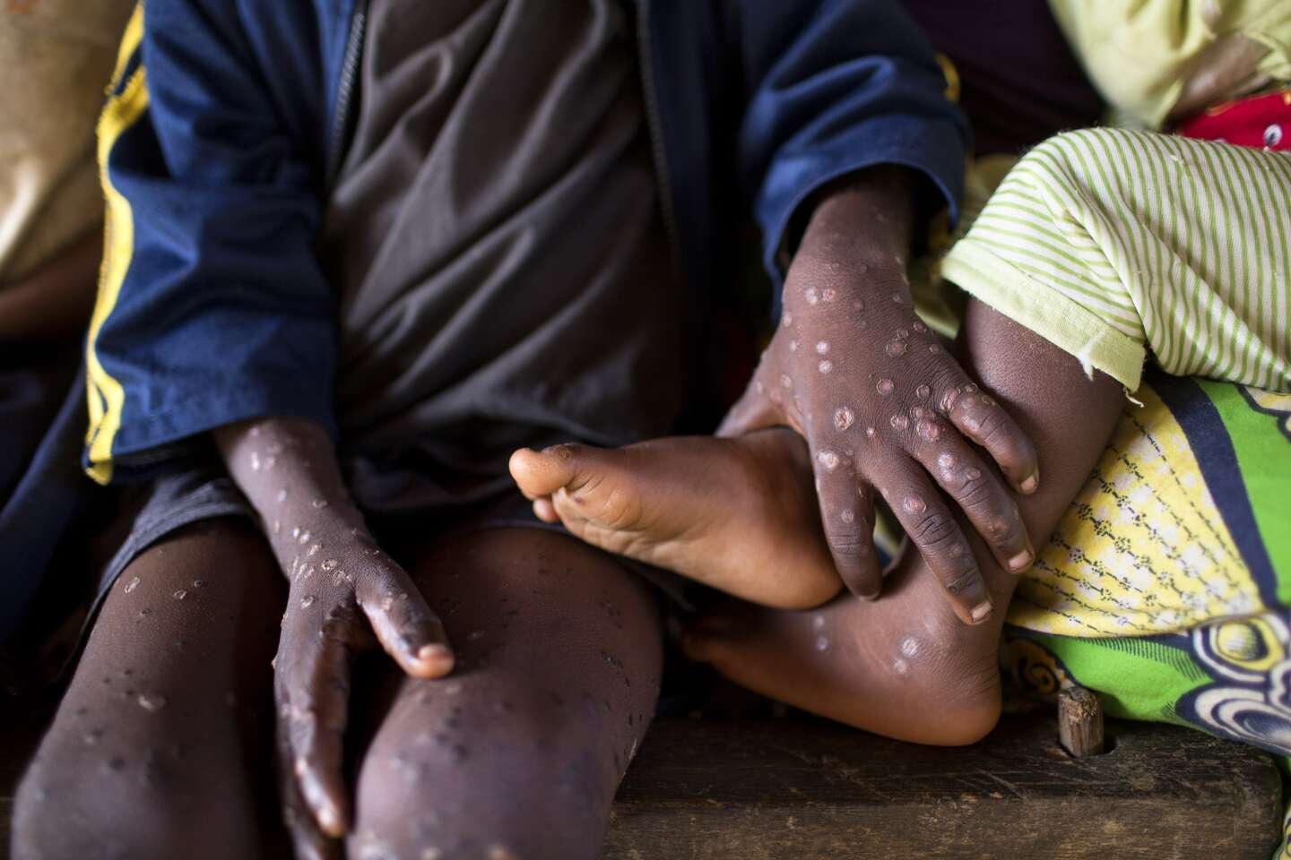 Variole du singe : les pays africains réclament un accès équitable au vaccin