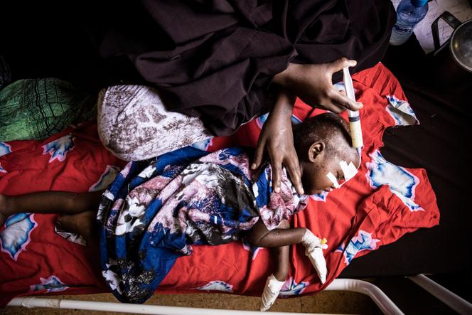 Un enfant de 2 ans souffrant de malnutrition sévère à l’hôpital Banadir, à Mogasdiscio, le 1er juin 2022.
