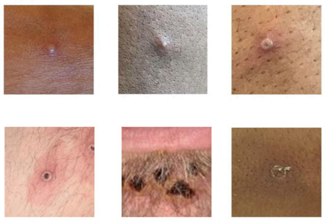Images showing examples of monkeypox rash collected from Centers for Disease Control and Prevention in the United Kingdom.