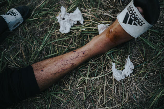 A migrant shows the wounds he got from trying to climb the fence for Hungary, in Horgos (Serbia), on August 23, 2022.