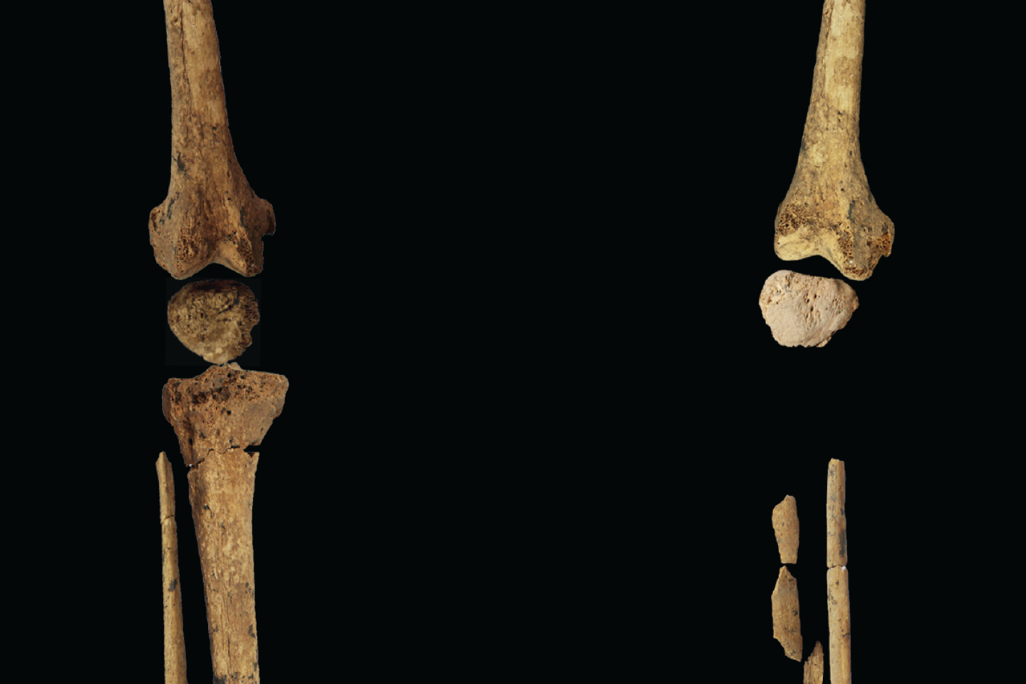 Une amputation sur un jeune chasseur-cueilleur a été réalisée il y a 31 000 ans sur l’île de Bornéo