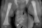 Un bébé naît avec un fœtus jumeau accolé à son testicule gauche