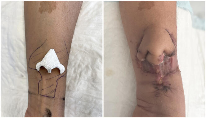 The graft made of biomaterial (left) was implanted “as a nurse” for nearly two months on the patient's forearm.