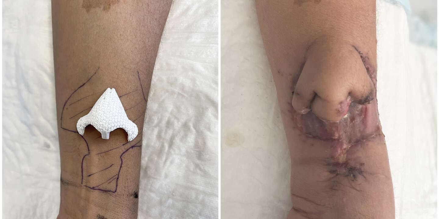 New nose successfully grown on French woman's arm