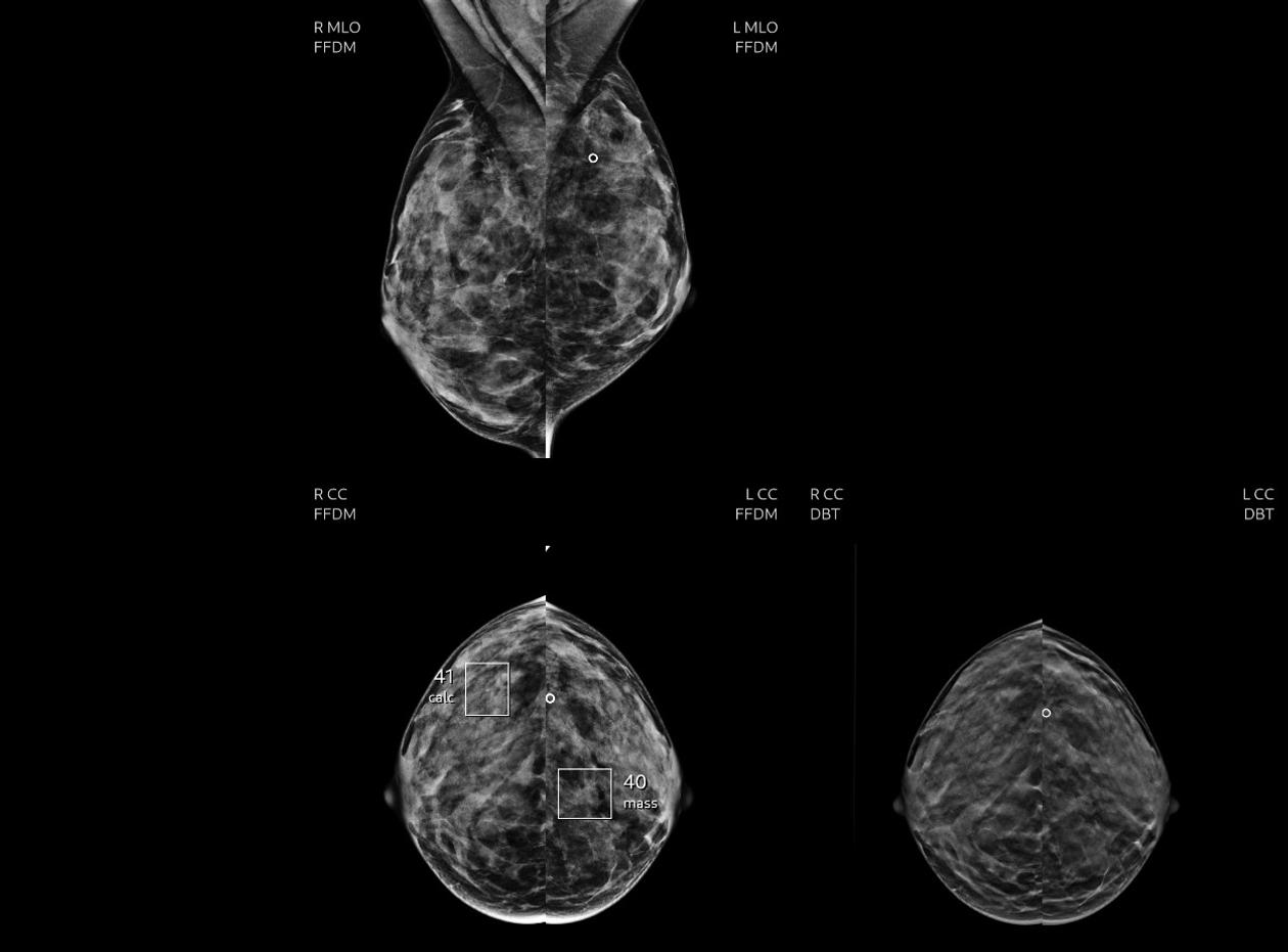 Deux lésions (de risque intermédiaire)  de cancer identifiées par l’IA à la mammographie, finalement bénignes,  à l’hôpital Tenon. 