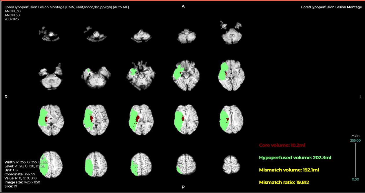 Après un AVC ischémique, l’IA permet d’évaluer le volume de cerveau potentiellement sauvable (en vert) à l’IRM. Ici, à l’hôpital de Garches.