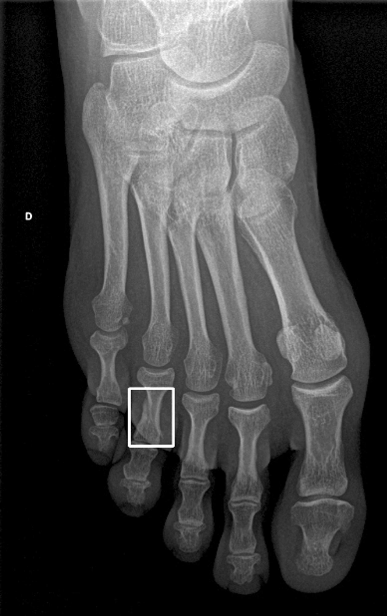 Radiographie du pied où l’IA indique la présence d’une fracture de la première phalange d’un orteil, aux urgences de l’hôpital Foch.