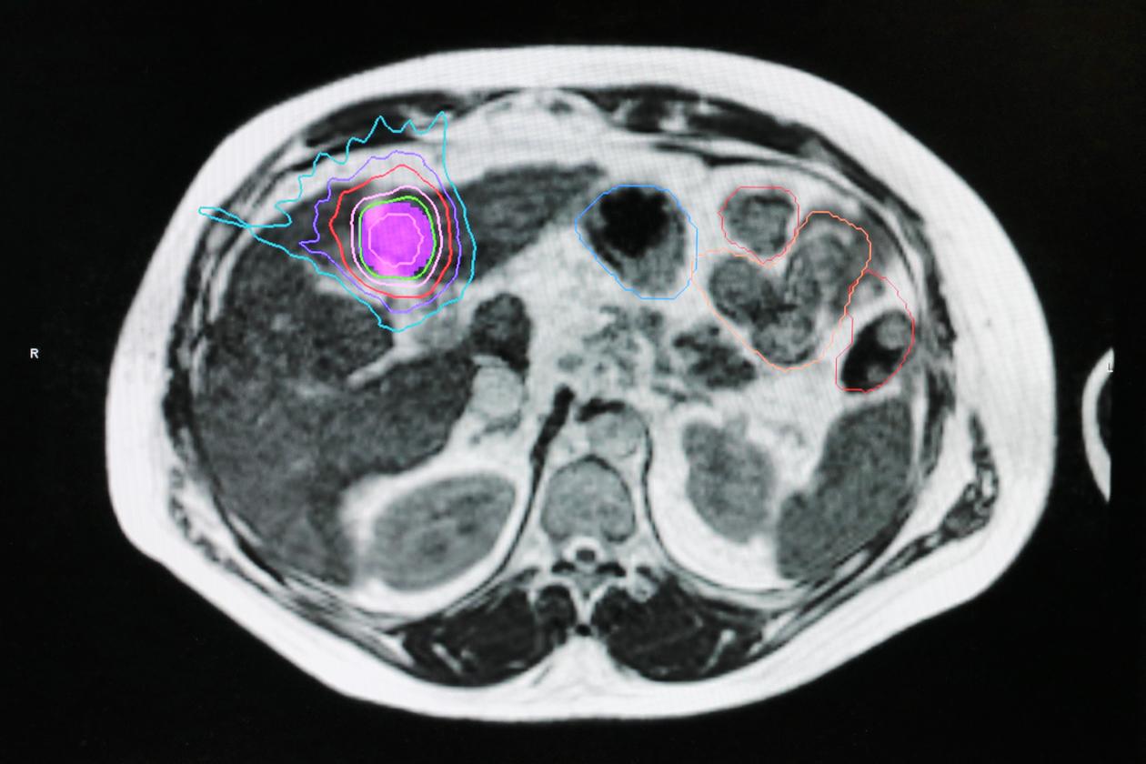 IRM abdominale où l’intelligence artificielle (cercles de couleur) permet de mieux cibler les cellules tumorales du foie en radiothérapie. 