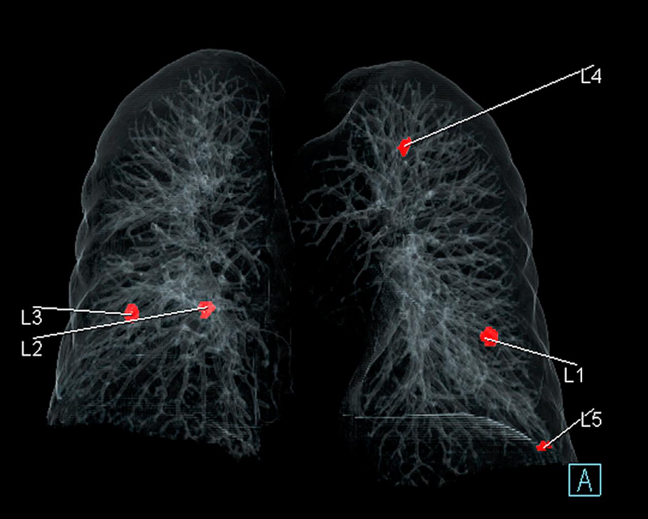  Détection de nodules pulmonaires cancéreux par l’IA au scanner, à l’hôpital Foch.