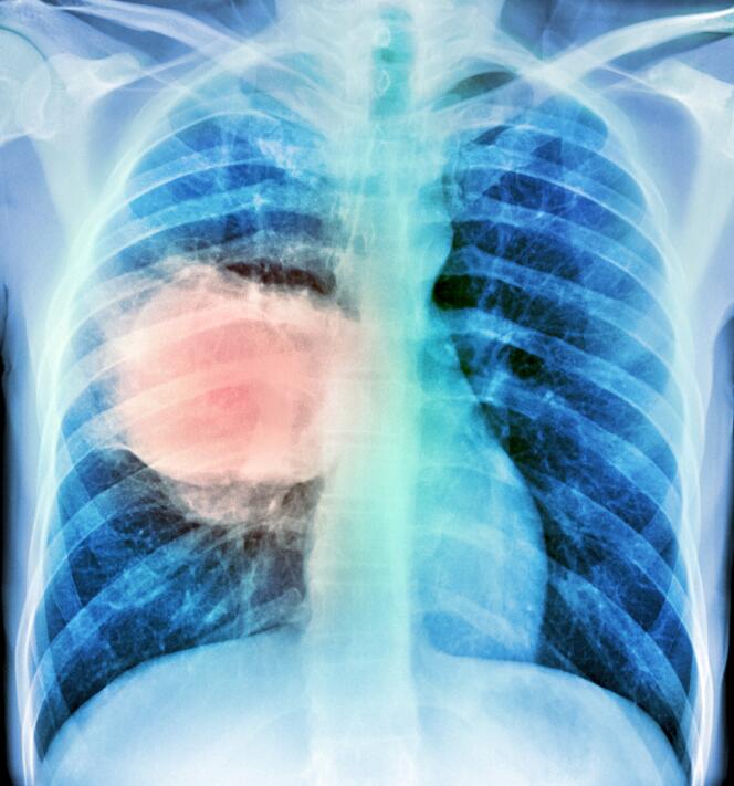 Une tumeur maligne du poumon (en rose), vue par radiographie. Le cancer broncho-pulmonaire est la première cause de mortalité par cancer en France et dans le monde.