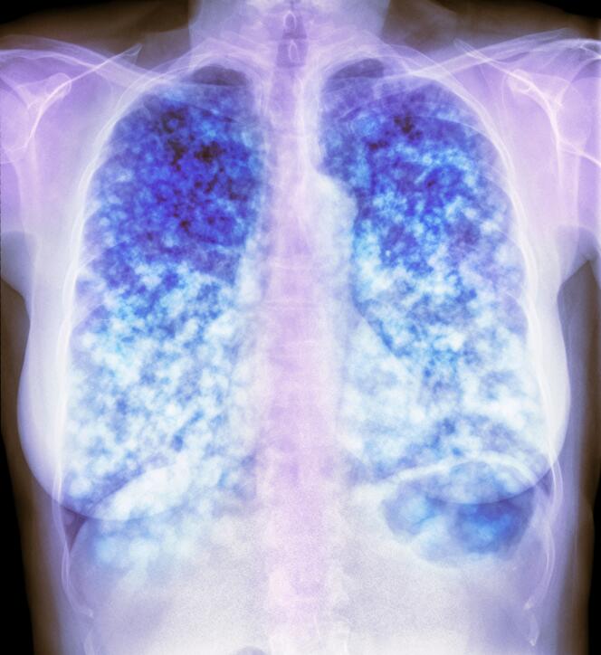 Secondary lung cancer.  Color chest x-ray of a section through the lungs (dark, left and right) of a patient with multiple malignant (cloud-like) lesions that have metastasized from cancer elsewhere in the body.