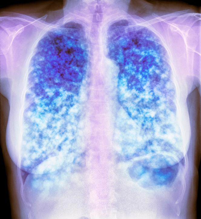 Secondary lung cancer.  Color chest x-ray in the lungs (dark, left and right) of a patient with multiple malignant (cloud-like) lesions that have metastasized from cancer to other parts of the body.