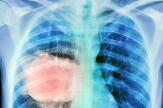 Cancer du poumon : la survie s’améliore en France