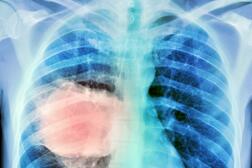 Une tumeur maligne du poumon (en rose), vue par radiographie. Le cancer bronchopulmonaire